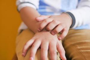 kind meisje dat lijdt aan jeukende huid bij de hand foto