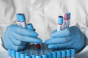 hand met beschermende handschoenen met bloedmonsters voor covid-test foto