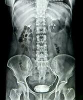 röntgenstraal beeld van menselijk torso vervagen en lawaai foto