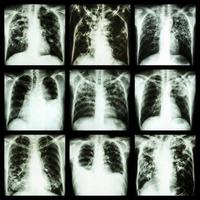 verzameling van longziekte pulmonale tuberculose pleurale effusie bronchiëctasie foto