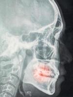 panoramische tandheelkundige röntgenfoto, met rood pijnlijk gebied foto
