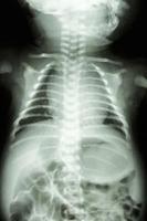 filmröntgenfoto toont normale borst en buik van baby foto