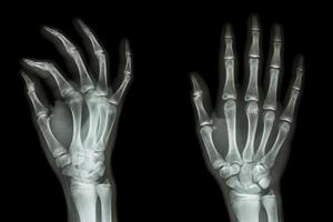 film x-ray hand ap schuine toon normale mensenhand foto