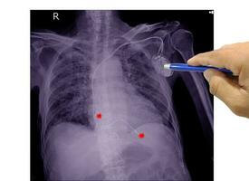 borst röntgenstraal film van een geduldig met blijvend pacemaker implantaat in borst lichaam foto