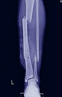 film x-ray meerdere breuk been scheenbeen en fibular foto