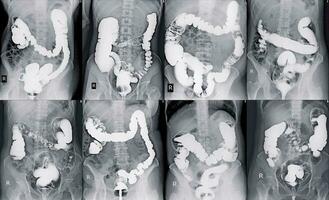 afbeelding van de dikke darm x-ray foto