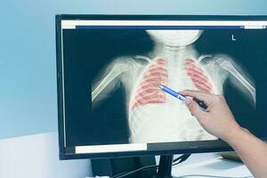 dichtbij omhoog artsen in beschermend kleding bespreken een röntgenstraal een kind van de longen ademhalings syncytieel virus foto