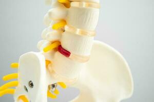 lumbaal wervelkolom verplaatst hernia schijf fragment, spinal zenuw en bot. model- voor behandeling medisch in de orthopedische afdeling. foto