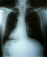 röntgenfoto, weergave van borstmannen voor medische diagnose. foto