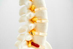 lumbaal wervelkolom verplaatst hernia schijf fragment, spinal zenuw en bot. model- voor behandeling medisch in de orthopedische afdeling. foto