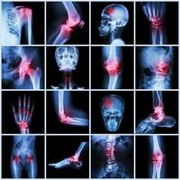 verzameling van menselijke gewrichten en artritis en beroerte; foto