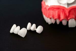 tanden implantaat en kroon installatie werkwijze onderdelen geïsoleerd Aan een zwart achtergrond. medisch accuraat 3d model. foto