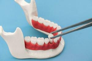 tanden implantaat en kroon installatie werkwijze onderdelen geïsoleerd Aan een blauw achtergrond. medisch accuraat 3d model. foto