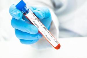 positief bloedinfectiemonster in reageerbuis voor covid-19 coronavirus foto