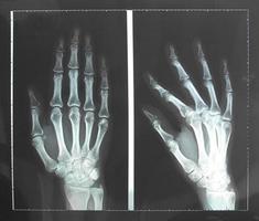 röntgenfoto van de hand foto