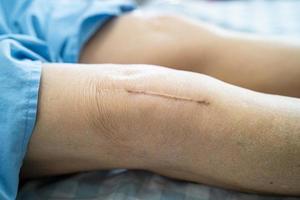 Aziatische senior vrouw patiënt laat haar littekens zien chirurgische totale knie foto