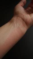 vrouwelijke hand bedekt met rode vlekken, close-up. allergische reactie foto