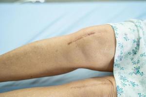Aziatische senior vrouw patiënt toont haar littekens chirurgisch totaal kniegewricht foto