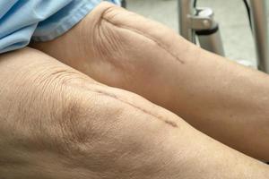 Aziatische senior patiënt laat haar littekens zien chirurgische kniegewrichtvervanging