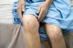 Aziatische senior patiënt laat haar littekens zien chirurgische kniegewrichtvervanging