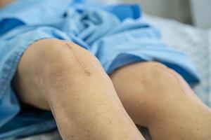 Aziatische senior vrouw patiënt laat haar littekens zien foto
