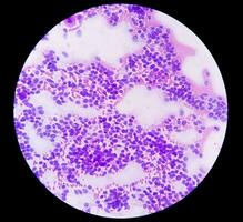 usg begeleid fna cytologie van lever Sol tonen niet hodgkin lymfoom. uitgezaaide carcinoom foto
