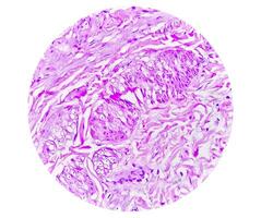 histologie van urachal cyste. microfoto van histologisch gebrandschilderd glijbaan tonen urachal cyste. urethraal cyste. foto