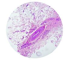 foto, prepatellair regio histologie tonen slijmbeursontsteking, acuut of chronisch bursitis. foto