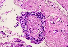 histologie van urachal cyste. microfoto van histologisch gebrandschilderd glijbaan tonen urachal cyste. urethraal cyste. foto