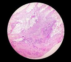 foto, prepatellair regio histologie tonen slijmbeursontsteking, acuut of chronisch bursitis. foto