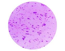 microfoto tonen neurofibroom. neurofibromatose, is een genetisch wanorde, gen mutaties. foto