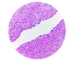 foto, prepatellair regio histologie tonen slijmbeursontsteking, acuut of chronisch bursitis. foto