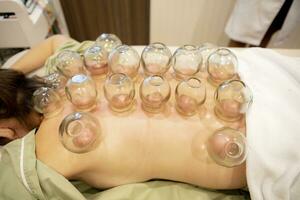 geduld ondergaan van Chinese cupping behandeling foto