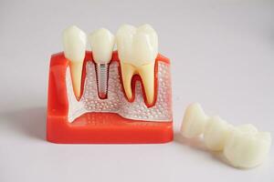 tandheelkundig implantaat, kunstmatig tand wortels in kaak, wortel kanaal van tandheelkundig behandeling, gom ziekte, tanden model- voor tandarts aan het studeren over tandheelkunde. foto