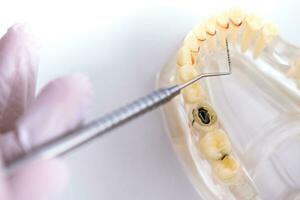 dokter orthodontist shows de instrument Aan cariës in de tanden foto