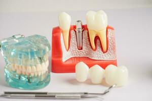 tandheelkundig implantaat, kunstmatig tand wortels in kaak, wortel kanaal van tandheelkundig behandeling, gom ziekte, tanden model- voor tandarts aan het studeren over tandheelkunde. foto