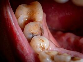 tand verval, gebroken tanden, mondeling Gezondheid arm tandheelkundig Gezondheid. mondeling Gezondheid problemen. loszittend, geel tanden, plaque en tandsteen Bij de rand van de tandvlees foto