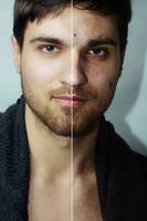 voordat en na kunstmatig operatie. jong mooi Mens portret foto