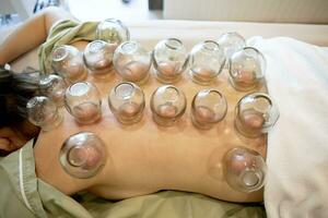 geduld ondergaan van Chinese cupping behandeling foto