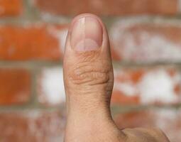 gevorkt nagel Aan de duim. verwijding van de nagel, traumatisch pathologie. de nagel is verdeeld in voor de helft foto