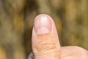gevorkt nagel Aan de duim. verwijding van de nagel, traumatisch pathologie. de nagel is verdeeld in voor de helft foto