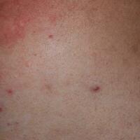 allergie huid terug en kanten. allergisch reacties Aan de huid in de het formulier van zwelling en roodheid foto