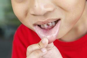 kind melk tanden vallen uit van gom. weinig jongen blijvend tand groeit in mond. schattig kind Open haar mond tonen tanden en tandvlees. concept van Gezondheid, tandarts, hygiëne, medisch, gezond tanden, tandheelkundig kliniek. foto