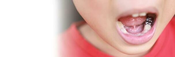 kind melk tanden vallen uit van gom. weinig jongen blijvend tand groeit in mond. schattig kind Open haar mond tonen tandheelkundig kroon en tandvlees. concept van Gezondheid, tandarts, hygiëne, medisch, gezond tanden, kliniek. foto