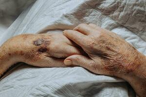 een blauwe plek Aan de hand- van een ouderen persoon. bekend net zo seniel purpura. veroorzaakt door de breekbaarheid van de huid en bloed schepen in oud leeftijd. ouderen zorg foto