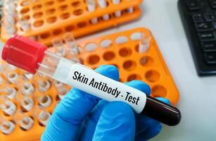 wetenschapper hand- Holding bloed monster voor anti huid antilichaam testen. foto