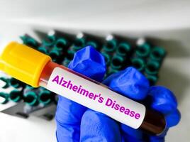 bloed testen voor diagnose de ziekte van Alzheimer ziekte. alzheimer ziekte oorzaak hersenen cellen degeneratie dat lood naar geheugen verlies en denken vaardigheden. foto
