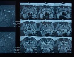 mri sacro-iliacaal articulatie. studie van ankylopoetica spondyloartritis geduldig. foto