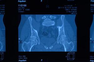 mri sacro-iliacaal articulatie. studie van ankylopoetica spondyloartritis geduldig. foto