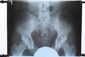 röntgenstraal van de bekken en heiligbeen. röntgenstraal foto